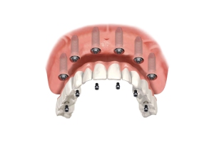 boca con 6 implantes